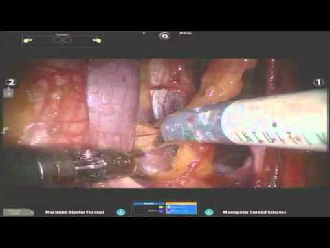 Extended Pelvic Nodes Excision - Robot Assistance