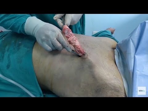 Patient Recovery Case — Video 12 (Body Sculpting)