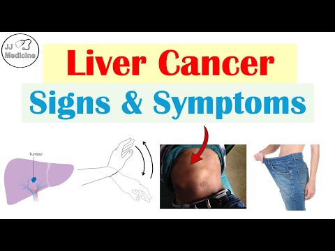 Liver Cancer (Hepatocellular Carcinoma) Signs & Symptoms (Why They Occur & Metastases)