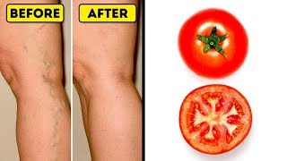 I Applied This Home Remedy To My Varicose Veins, Now They