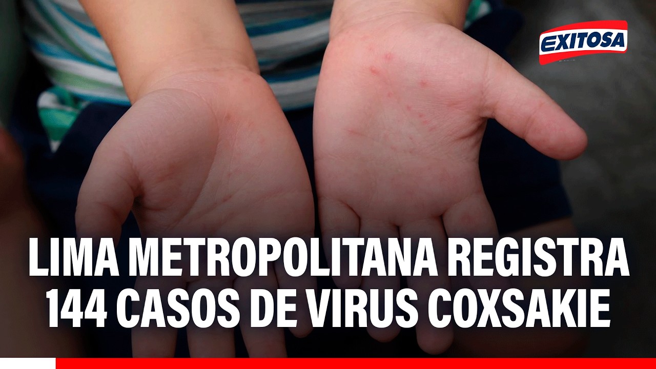 🔴🔵 Lima Metropolitana registra 144 casos de virus Coxsackie en 35 colegios