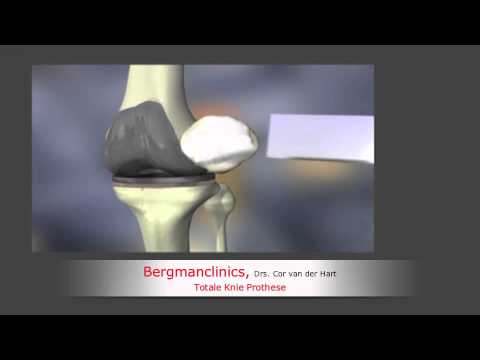 Hydrops des Schultergelenkes Verband auf dem Kniegelenk Video