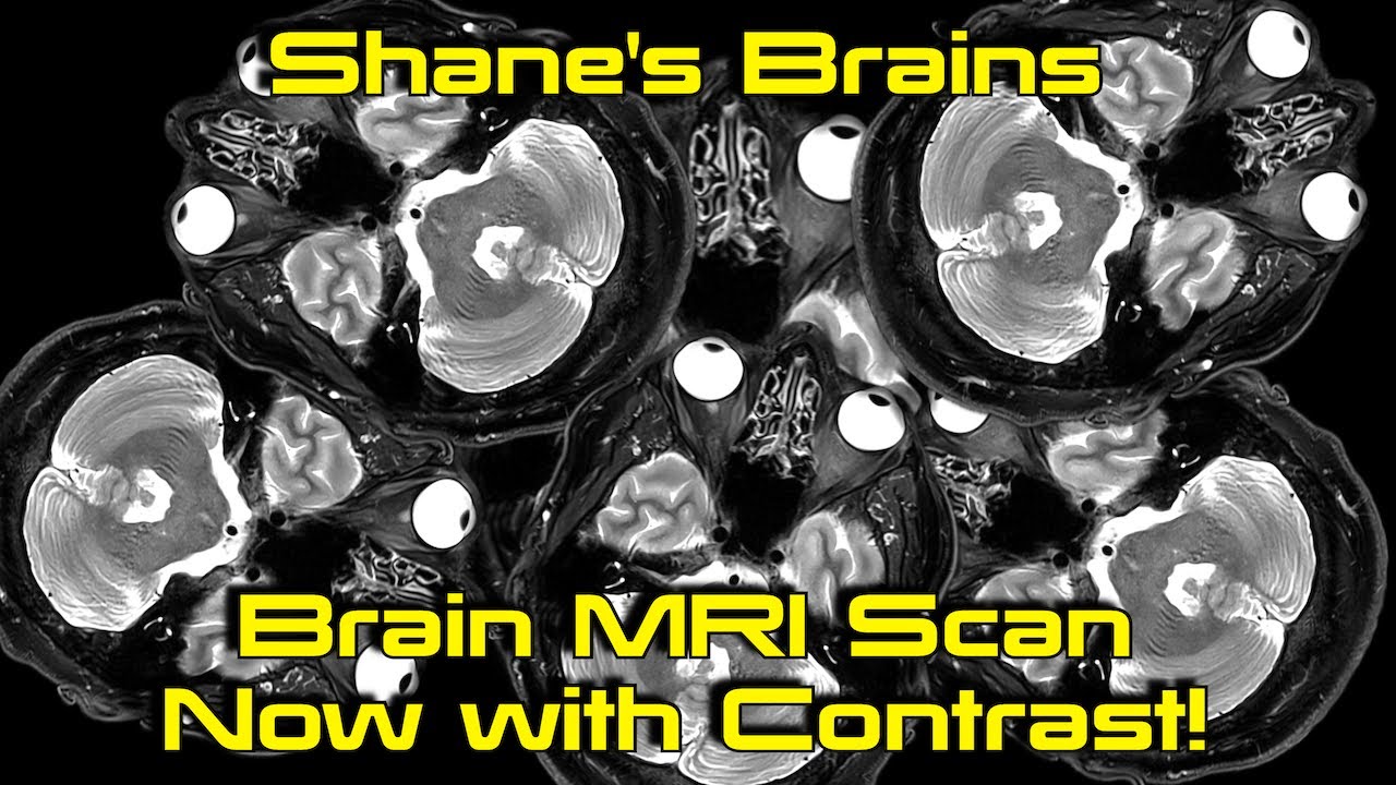Shane’s Brains! MRI Scan - October 2023