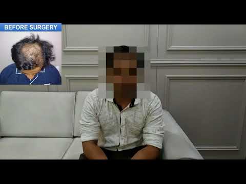 Hair Transplant in Ahmedabad at Rejuva Aesthetica