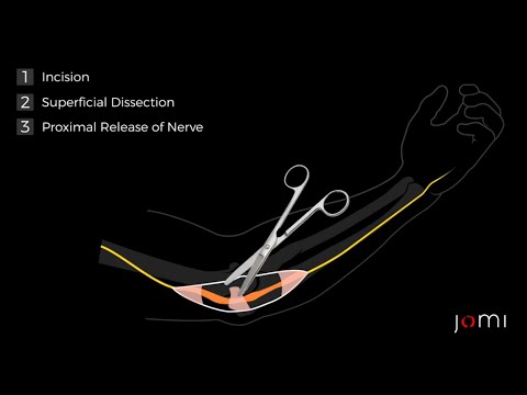 Cubital Tunnel Release: Animation