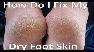 Dry, Itchy & Cracked Foot Skin [Home Treatment & Best Remedies!]