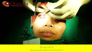 ทำตา 2 ชั้น Chanisa Cosmetic Clinic
