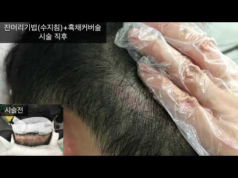 Let's get rid of the scar on the scalp with tattoos!