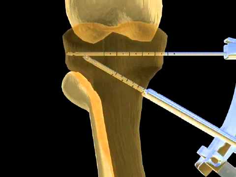 Insufficienza vertebrobasilare allosteocondrosi cervicale Sinovite del ginocchio Wikipedia