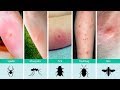 Ouch, What Bit Me? How to Identify Common Bug Bites and What To Do About It