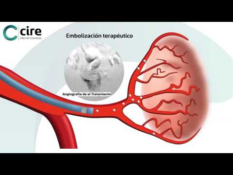 Adenom der Speicheldrüsen der Prostata Prostatakrebs so lange mit ihm leben