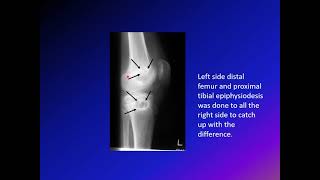 Hemihypertrophy