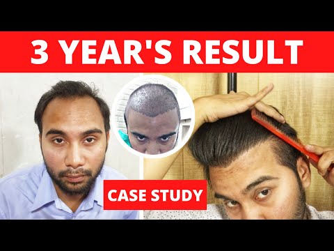 Case Study : My Hair Transplant Results After 3 Years...