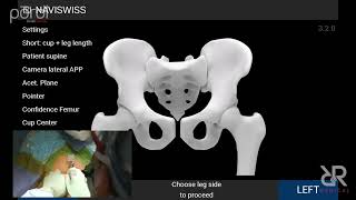 Dr. Stefan Kreuzer performs Total Hip Arthroplasty Using IOT Purist Table at INOV8 Surgical.