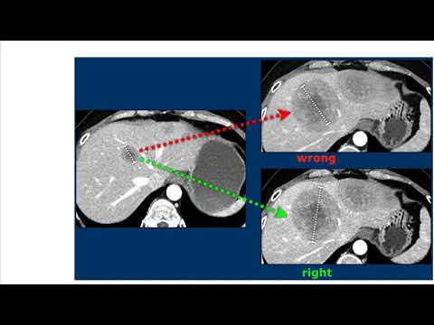 Critérios radiológicos para a avaliação da resposta de tumores sólidos (RECIST 1.1) - parte 1