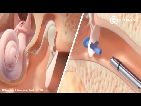 Ear Tube Insertion Procedure (Tympanostomy): Hummingbird in-office Tympanostomy System
