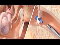 Ear Tube Insertion Procedure (Tympanostomy): Hummingbird in-office Tympanostomy System