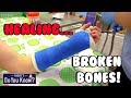 How Do You Make A Plastic Cast For Broken Bones Maddie S Do You Know