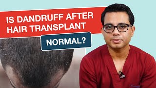 Dandruff After Hair Transplant- Causes & Treatment | Best Hair Transplant Surgeon- Dr.Jangid | Delhi