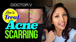 Doctor V - How To Treat Acne Scarring | Skin Of Colour | Brown Or Black Skin