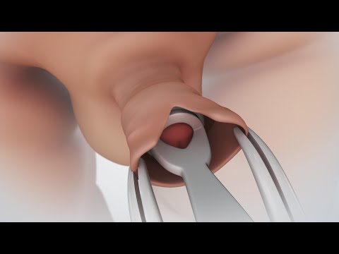 Cum este pompat penisul