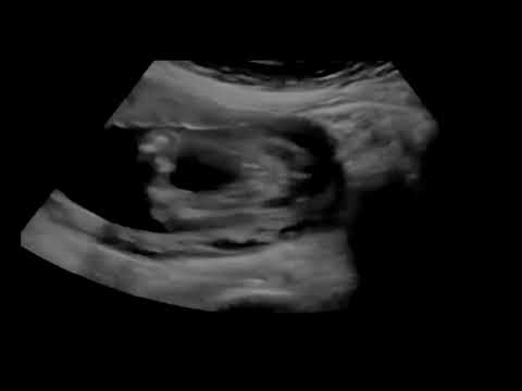 Baby Ultrasound 1 Hour White Noise (Dim Screen)
