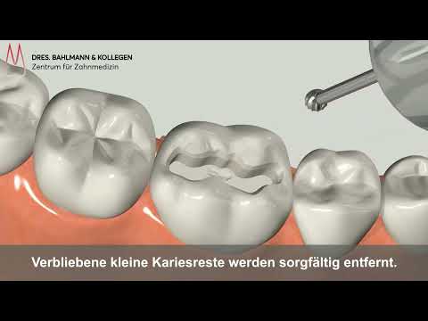 Zahnfüllung Köln - Erklärvideo - Ablauf