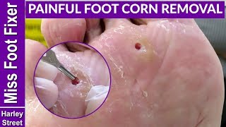 Satisfying deep corns removal with callus