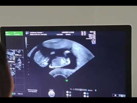 Ecografia 12 settimane Bi-test feto traslucenza nucale