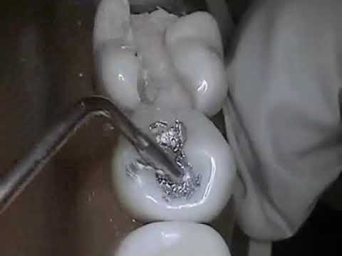 A basic procedure to show how a dental filling is done. The video explains dental filling treatment in detail (STEP 4) by the dentist in Hindi language. Step 1 : Cavity Preparation Step 2 : Isolation Step 3 : Fluoride Varninsh Application Step 4 : Placement of Dental Filling Dentists at Peoples Dental Clinic suggest the best type of dental filling to their Patients. Our Child Dentist ( Pediatric Dentist ) suggests GIC restoration filling in teeth of kids.
Category
Dentist, Dental Clinic, Child Dentist, kids dentist, pediatric dentist, best dentist, best dental clinic, dentist in greater noida
dentist near me
