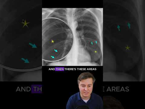 Emphysema on chest x-ray
