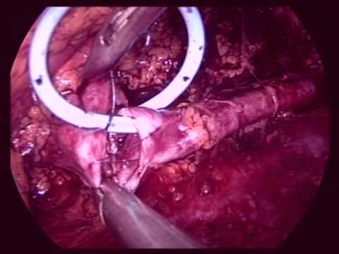 Ureteropelvic Junction Obstruction - Pyeloplasty Retroperitoneal