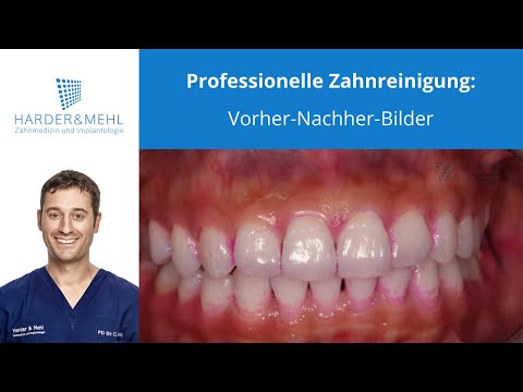Professional teeth cleaning: before and after pictures