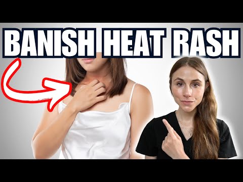 Banish Heat Rash Fast - Dermatologist Approved Methods