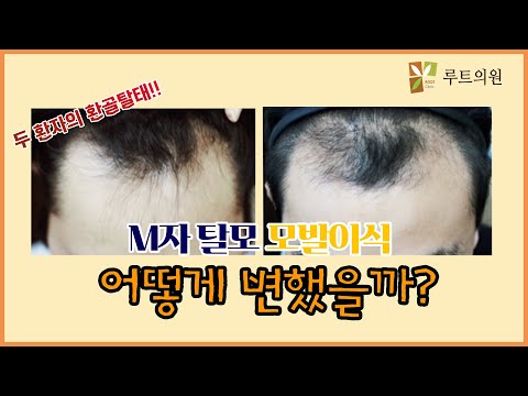 M자 탈모 두 환자분의 모발이식 결과는?