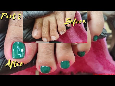 Vlog 535|Dry Skin/Ingrown Removal| PEDICURE 435