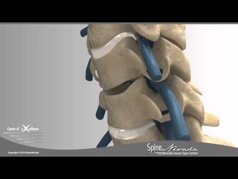 ACDF Anterior Cervical Discectomy & Fusion in Reno, Sparks, Carson City at Swift Institute