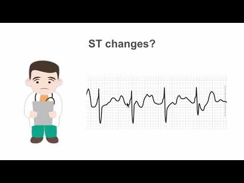 Recognizing ST segement changes on the stress ECG (EKG)