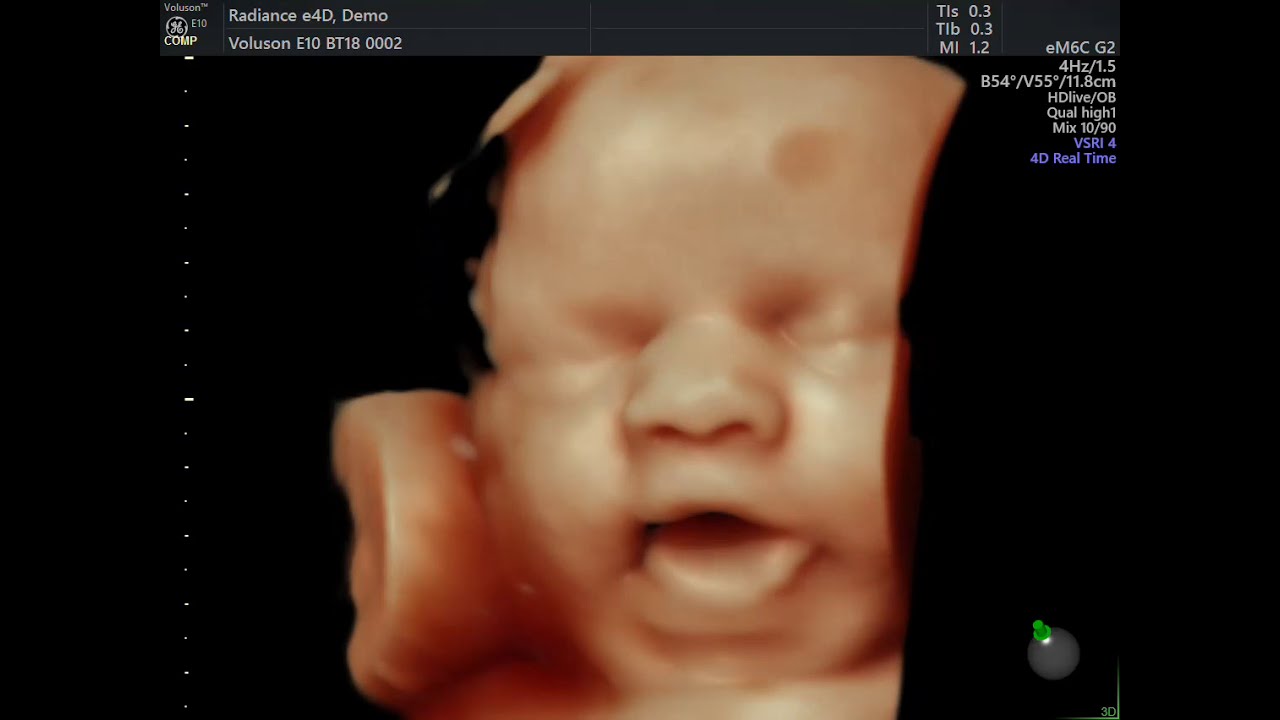 3D 4D EM ULTRASSON OBSTÉTRICO DE 30 SEMANAS