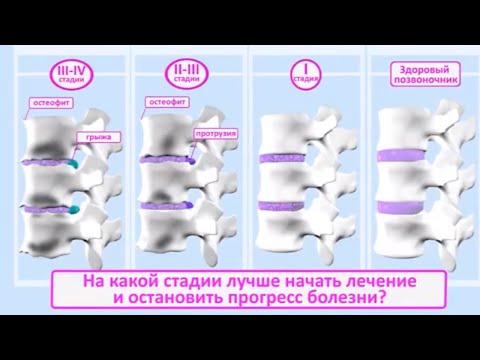 Как укрепить мышцы шеи видео при остеохондрозе Лечение суставов в санаториях россии