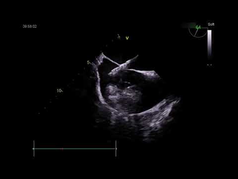Transseptal VIV Edwards SAPIEN 3® TMVR