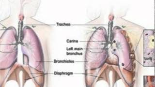 Understanding Lung Cancer, Part III:  Staging