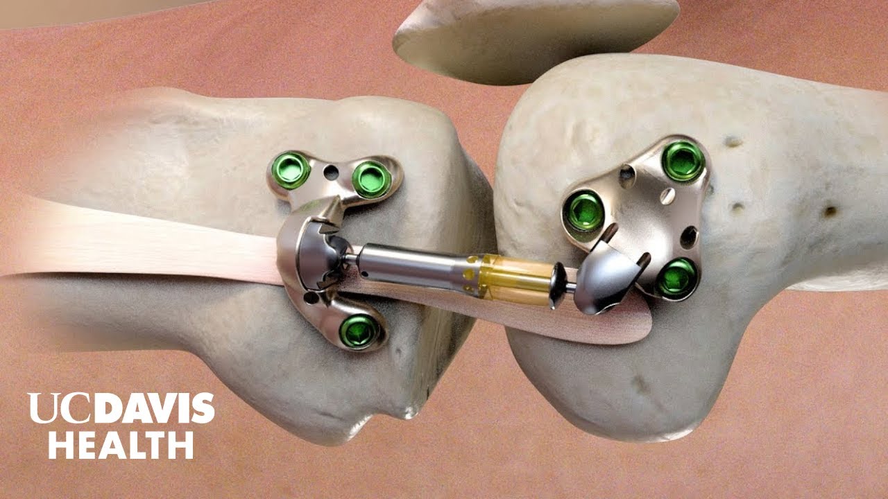 Thumbnail preview of 'Shock Absorber' for Knee Pain - UC Davis Among First to Place MISHA Implant for Osteoarthritis