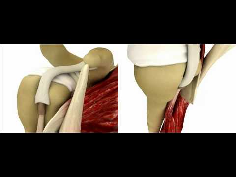 subscapuris rupture and biceps dislocation (instability)
