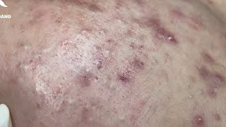 Relaxing Acne Removal with Linh Mydang #578