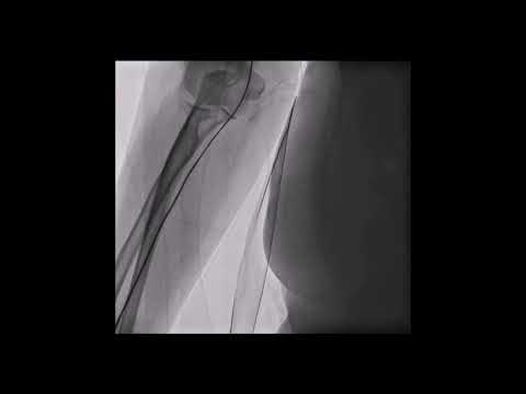 J wire Tipped Manipulation for Dealing with Severe Radial Artery Tortuosity