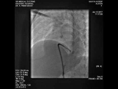 Device closure of perimembranous VSD without Arteriovenous loop formation