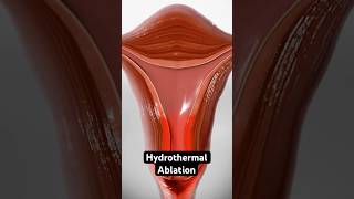 Using heated fluid to stop heavy periods (3D Animation)
