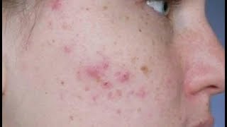 how to heal skin after picking acne