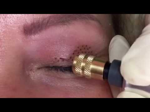 Lidstraffung ohne OP/ FIBROBLAST PlasmaPen